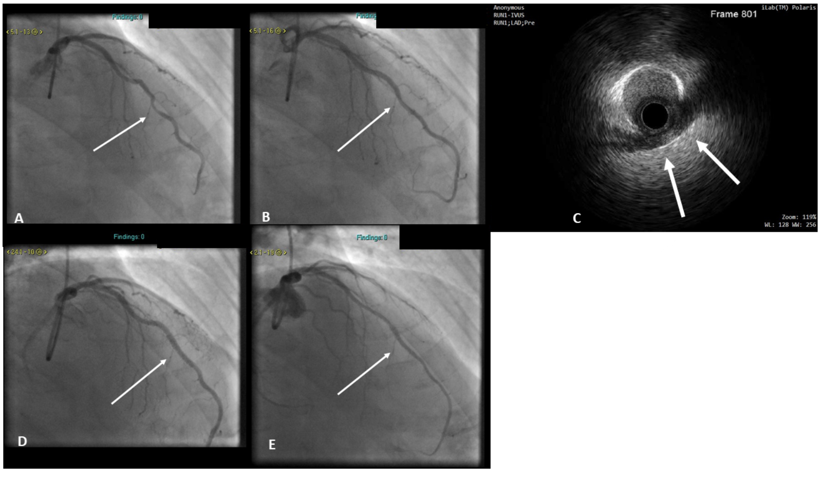 PCI and Stenting for Treatment of Myocardial Muscle Bridges JIC